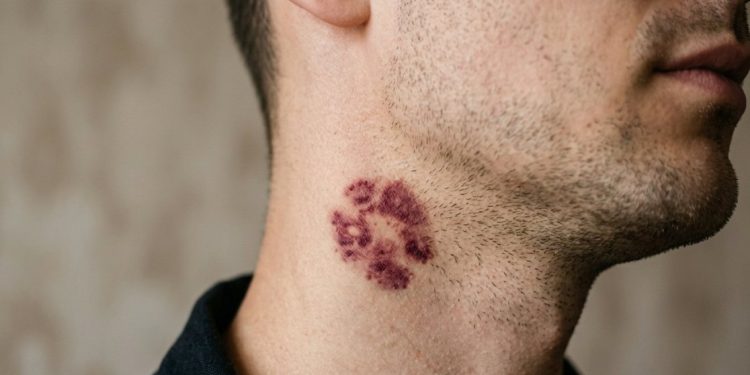 Hiki, ili ljubavni ugriz na vratu