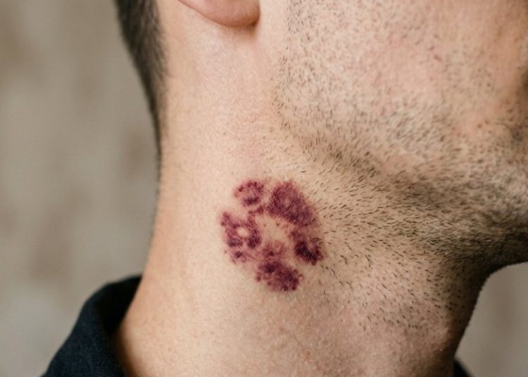 Hiki, ili ljubavni ugriz na vratu